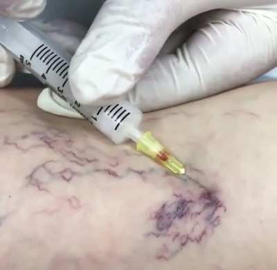 Spider veins (telangiectasias) disappearing almost immediately