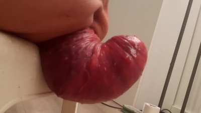 Prolapse stool