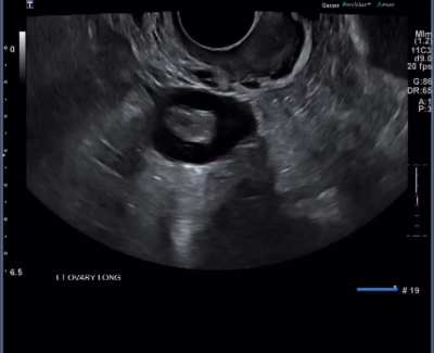 Is my pcos bad or could it be way worse ? 