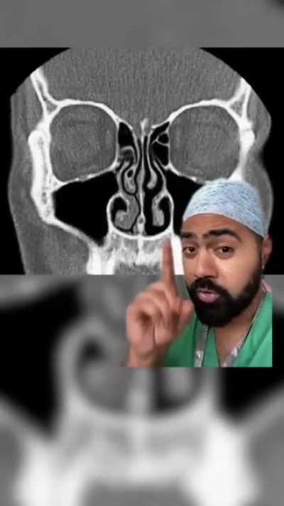 Trouble breathing through the nose.