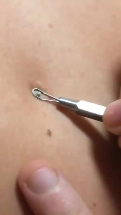 OP is a nurse, so their friend asked them to take a peek at her back. Bit of a scream at the end. (x/popping)