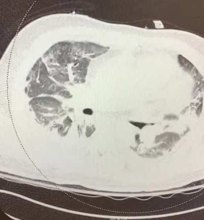 &ldquo;Recovered&rdquo; from CV19
