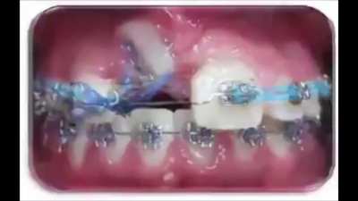 Br ish people be lik this XDD wear BRACES you BRi ISH!!