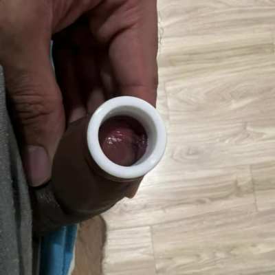 My phimosis journey