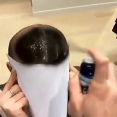 SLPT for baldness