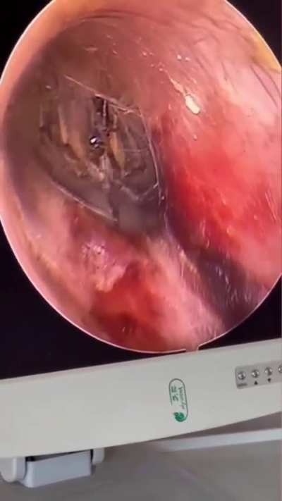 Spider crawls in a guy&rsquo;s ear while he slept