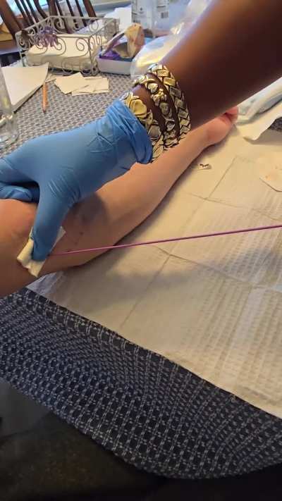 PICC Line Removal