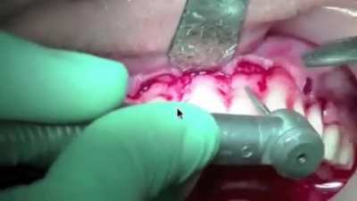 "Aesthetic Crown Lengthening"