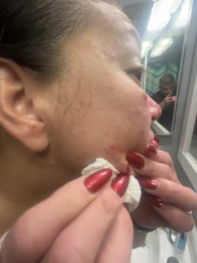 Wife has this on her face and man it keeps coming back! But it was a hell of an ooze.