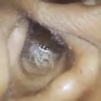 Man complains about constant itching &amp;amp; bizarre scratching sounds only to find this in his ear