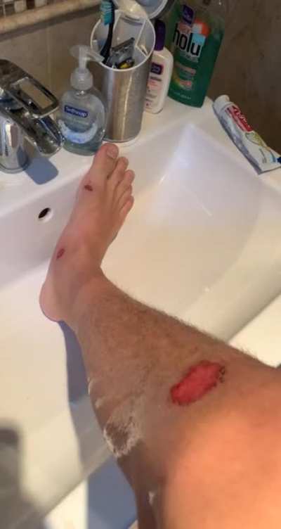 It stings very much