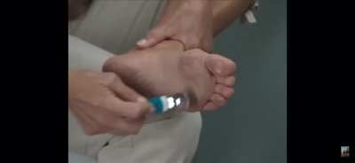 Getting rid of calluses