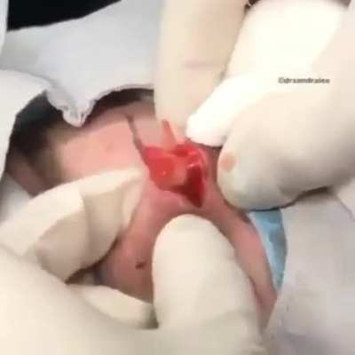 Head cyst!!