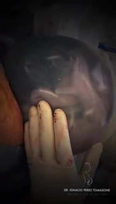 It's Crazy Seeing A Human Born Like This With The Sac Intact!