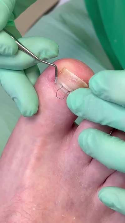 So many painful ingrown toenails here :(