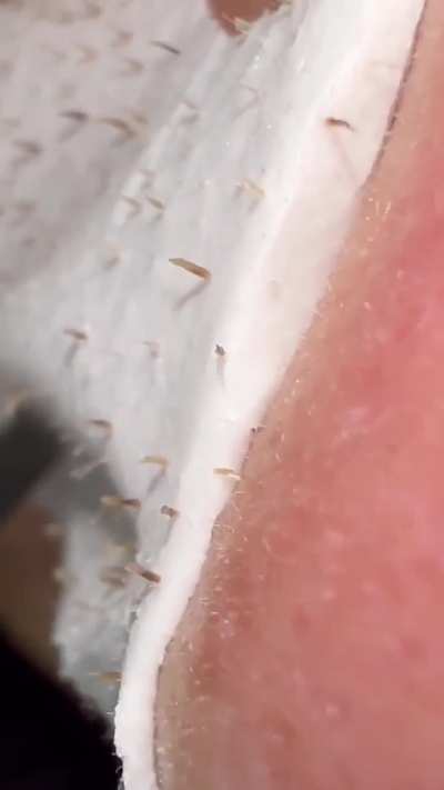 Pore cleaning close look..