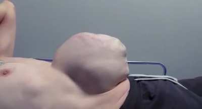 Hernia
