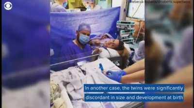 This woman gave birth to &ldquo;super twins&rdquo; which is called a superfetation meaning she got pregnant while she was pregnant