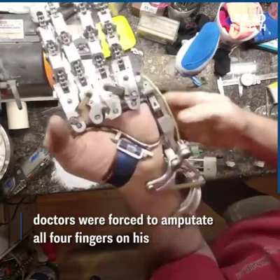 Engineer, Ian Davis lost 4 fingers in a work accident so he built himself a bionic hand.