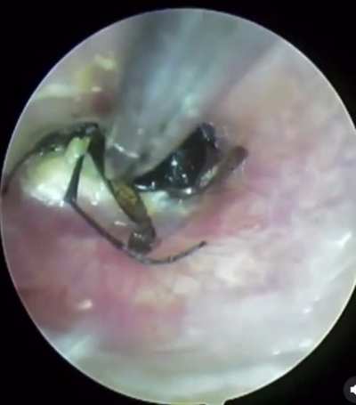 Wasp pulled out of man&rsquo;s ear