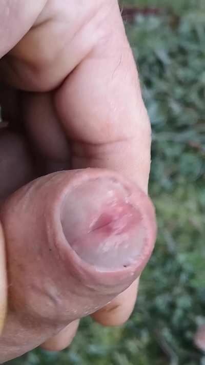 (39) skin is wet. 
