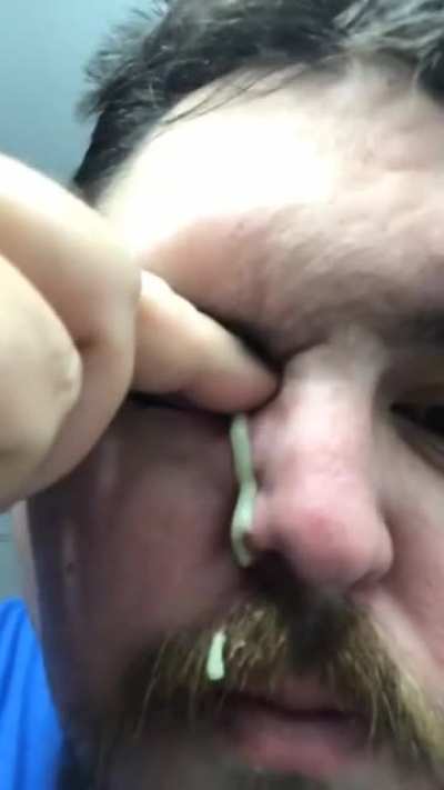 BLACKHEADS ON EYE!