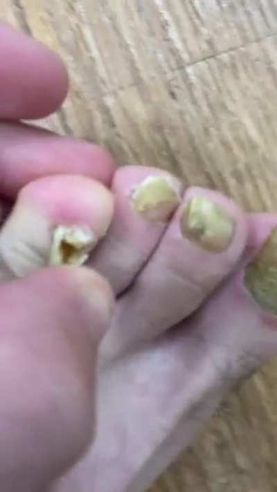 My loose, ingrown toenails🦶🤢