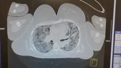 lung affected 100% by SARSCoV2, the gray images in the center should be black.