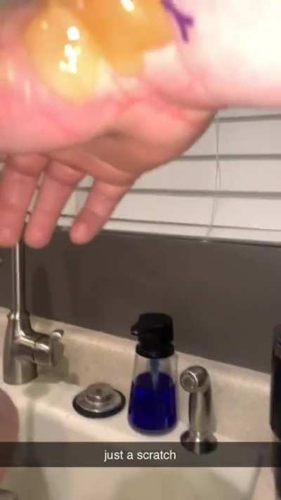 My friend burned his hand with gas on accident ! He says &ldquo;just a scratch&rdquo; that look like it hurt 🤣