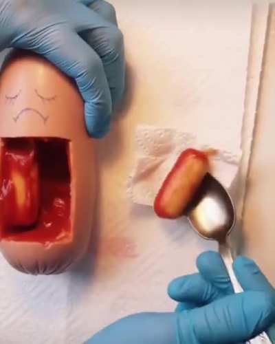 They did surgery on a hotdog