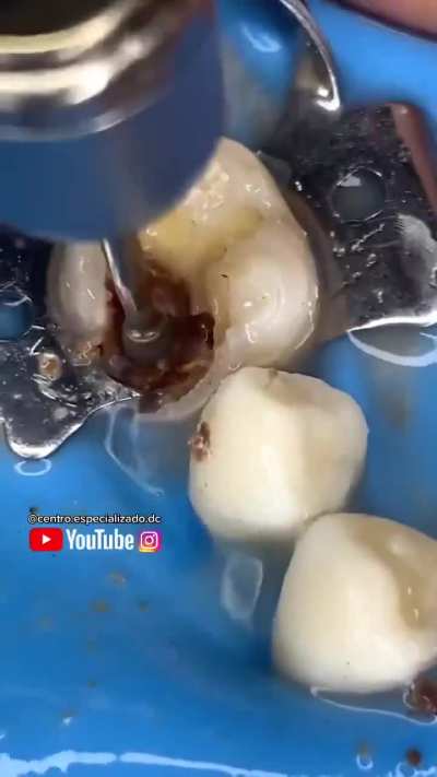 Drilling out tooth decay.