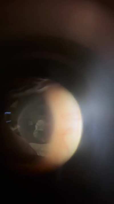 My sister is an optometrist and was able to get a video of my floaters!