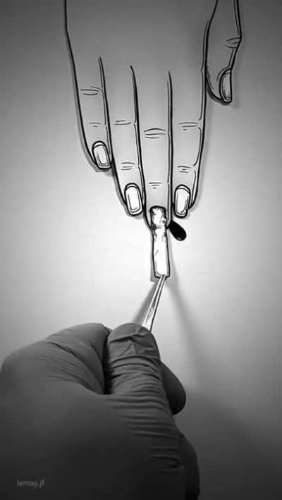 Hang Nail