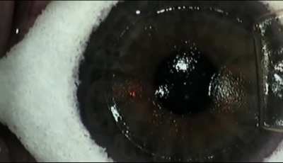 Laser eye surgery 