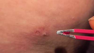 Stubborn thigh pluck