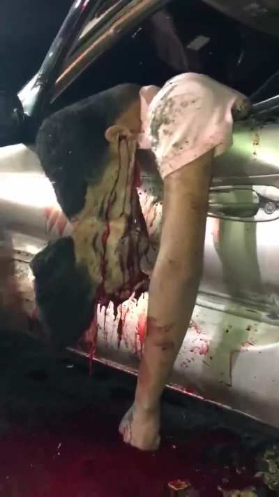 Aftermath of high speed head on with a semi..18+ very graphic. Impacted so hard the skin was ripped out from his skull